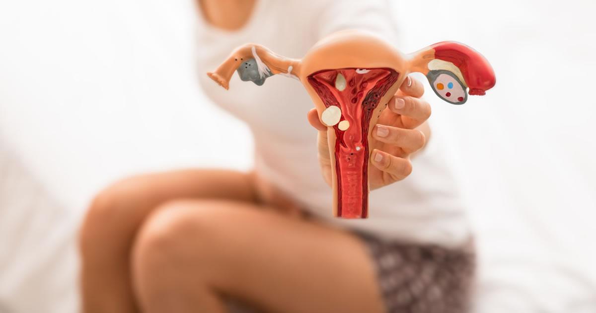 Endometriose: o que é, sintomas e se tem cura