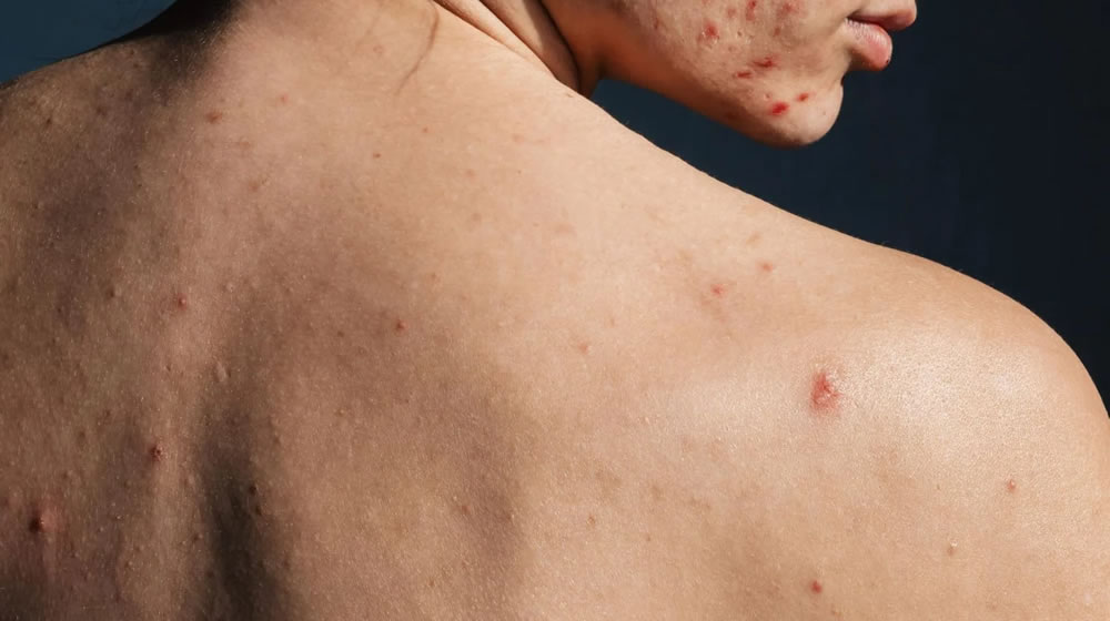 Acne adulta: por que aparece e como cuidar da pele?